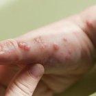 Casos de viruela del mono aumentan un 77 % en el mundo en una semana