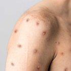 El MSP no precisa detalles sobre el tercer contagiado y anuncia que alista lineamientos de respuesta ante la declaratoria de emergencia internacional.