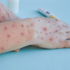 La actual viruela del mono tiene síntomas diferentes a brotes anteriores