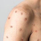 La OMS da nuevos nombres a las variantes de la viruela del mono