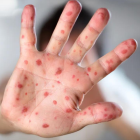 Los casos de viruela del mono continúan en aumento en Ecuador.