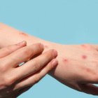 El mundo supera los 50.000 casos de viruela del mono