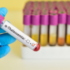 La detección temprana puede cambiar la vida de quienes heredan esta condición genética.