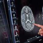 El descubrimiento detecta un camino en tres hitos hacia la pérdida de memoria