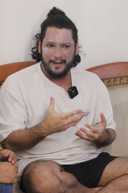 Felipe Crespo muestra las secuelas de la dermatitis en su rostro mientras relata cómo un accidente y problemas económicos cambiaron su vida.