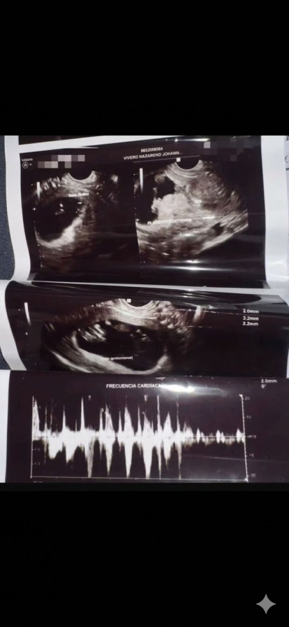 La prueba del eco donde se confirma el embarazo.